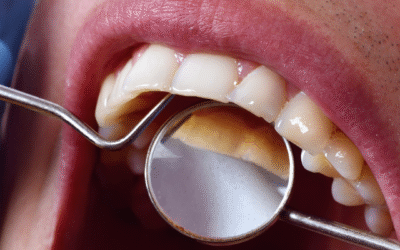 Why Oral Cancer Screenings Matter at Every Dental Checkup